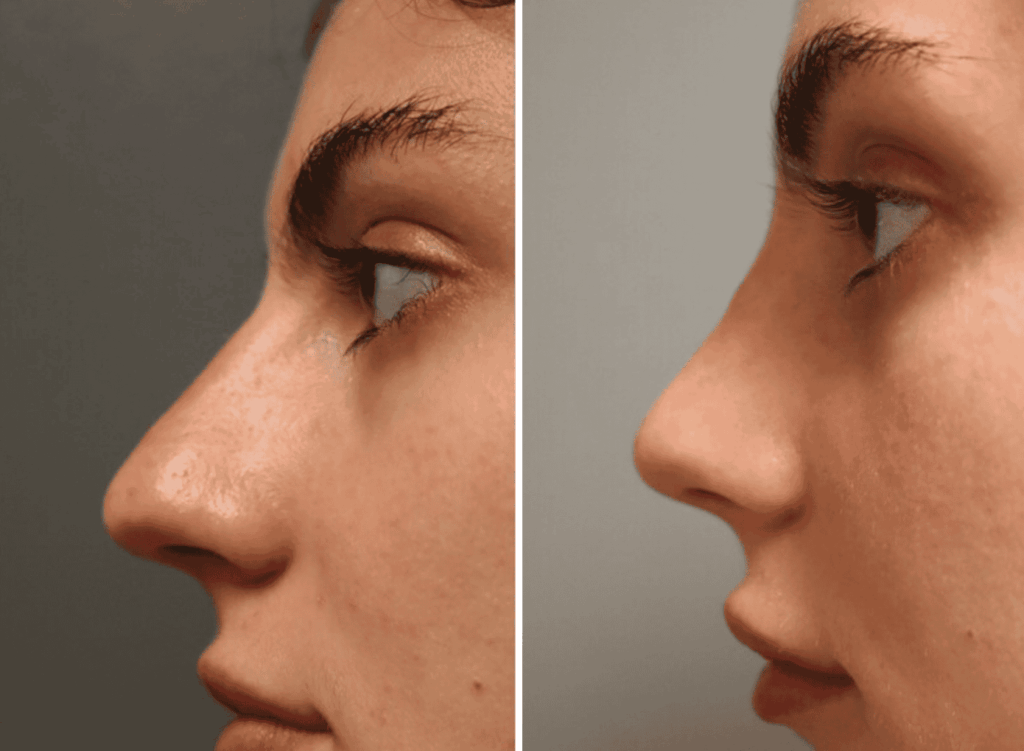 A profile shot of a patient showing the before and after of a rhinoplasty near Brentwood, TN